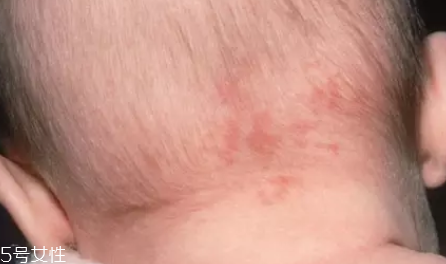 痣什么情況下會轉變為瘤？點痣不可取