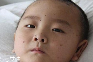 痣什么情況下會轉變為瘤？點痣不可取