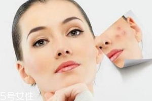痘印多久能自行消失？多數人一年內消失