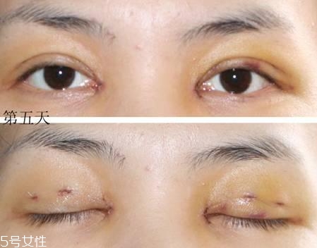 怎么縮短開眼角疤痕消失時間？雙眼皮開眼角恢復過程