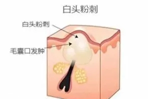 閉口是怎么引起的？4種情況要注意