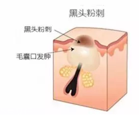 閉口是怎么引起的？4種情況要注意