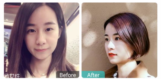 下瞼整形多久能恢復自然？半年時間