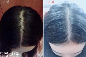 柳屋生發水有用嗎？一個月后長出新發