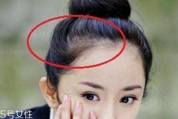 發際線低可以脫毛嗎 可以有效改善