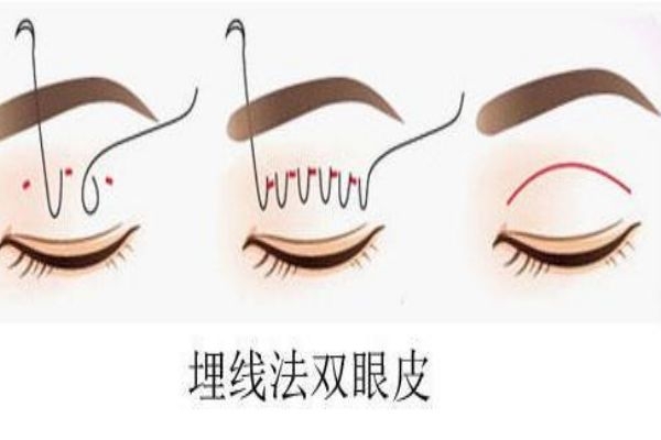 埋線雙眼皮感染怎么辦？埋線雙眼皮發炎了怎么辦