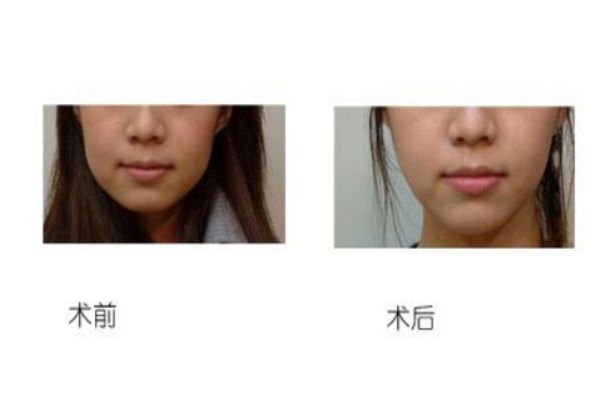 墊下巴前后對比照片 墊下巴的優缺點