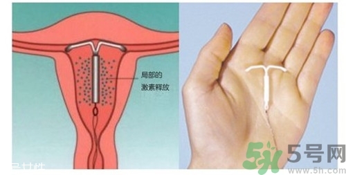 上環(huán)是什么意思？上環(huán)后注意事項(xiàng)有哪些？