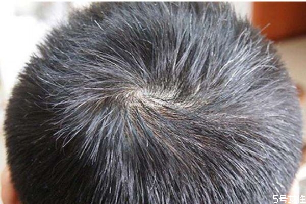 白頭發(fā)是怎樣引起的 怎樣預防白頭發(fā)