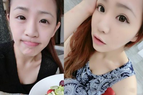 上瞼松弛變美術是什么 上瞼松弛變美術術前要注意什么