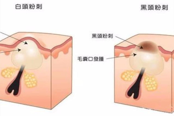 毛角周化和閉口的區別 毛角周化和閉口怎么區分