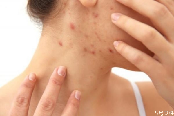 如何治療痘痘和閉口粉刺 痘痘和閉口粉刺的區別