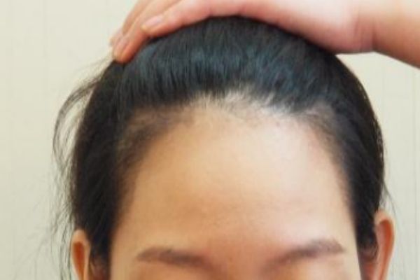怎么樣讓發際線變低 如何讓發際線前移