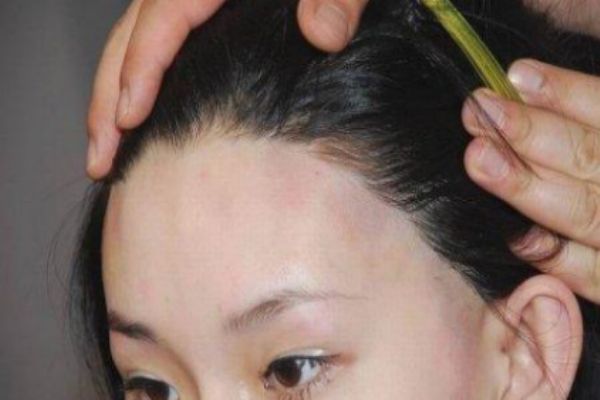 怎么樣讓發際線變低 如何讓發際線前移