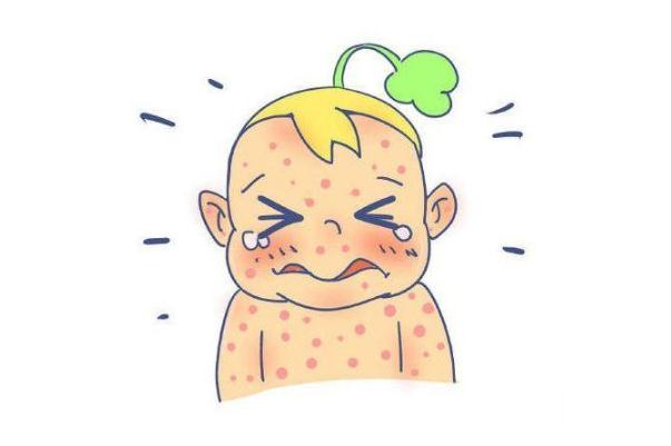 蕁麻疹會引起什么并發癥 蕁麻疹會引起高燒嗎