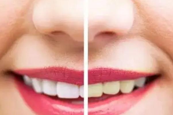 冷光美白牙齒會很白嗎 冷光美白牙齒對四環素牙有用嗎