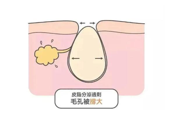 皮膚出油的表現 皮膚出油的好處