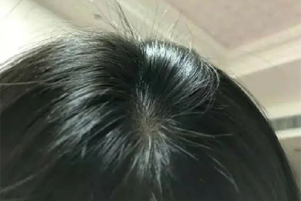 頭發出油要用什么洗發水 頭發出油用香皂洗頭可以嗎