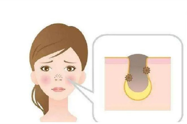 水果湖愛漾皮膚管理中心清潔毛孔后感覺(jué)怎么樣 清潔毛孔是去角質(zhì)嗎