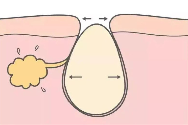 水果湖愛漾皮膚管理中心清潔毛孔后感覺(jué)怎么樣 清潔毛孔是去角質(zhì)嗎