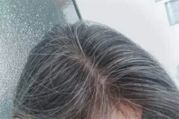 白頭發和性生活頻繁有關系嗎 白頭發是腎陰虛還是腎陽虛
